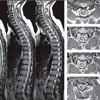 diagnosi di osteocondrosi toracica