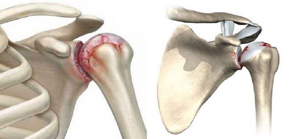 distruzione dell'articolazione della spalla con artrosi